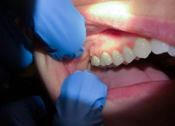 Best Emergency Gum Pain Relief  in Gueydan, LA