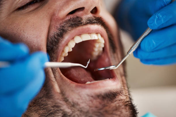 Teeth Whitening in LA